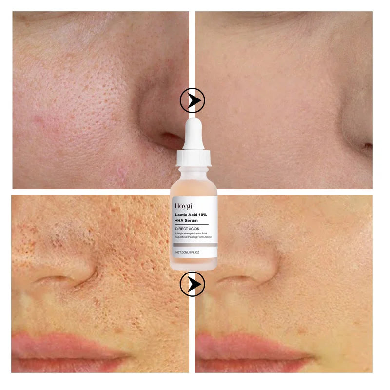 Lactic Acid Face Serum – Tightens Pores & Moisturizes Skin